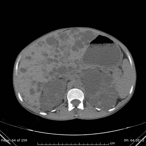 Autosomal dominant polycystic kidney disease (Radiopaedia 44122-47684 Axial non-contrast 23).jpg