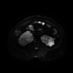 Autosomal dominant polycystic kidney disease (Radiopaedia 50259-55611 Axial DWI 30).jpg
