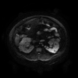 Autosomal dominant polycystic kidney disease (Radiopaedia 50259-55611 Axial DWI 95).jpg