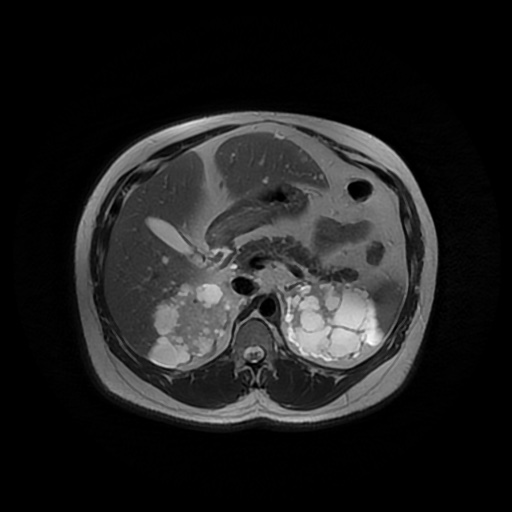 File:Autosomal dominant polycystic kidney disease (Radiopaedia 50259-55611 Axial T2 17).jpg