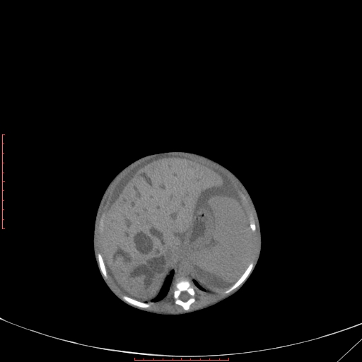 Autosomal recessive polycystic kidney disease associated with Caroli disease (Radiopaedia 61932-69984 Axial non-contrast 126).jpg