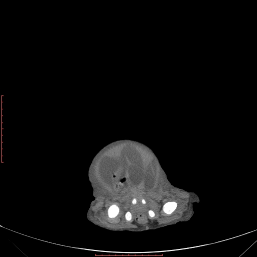 Autosomal recessive polycystic kidney disease associated with Caroli disease (Radiopaedia 61932-69984 Axial non-contrast 350).jpg