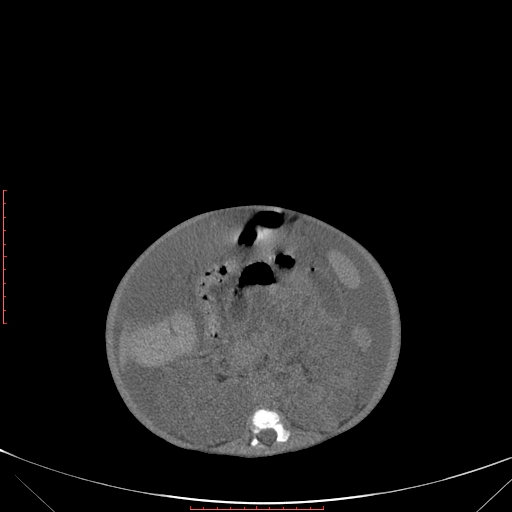 Autosomal recessive polycystic kidney disease associated with Caroli disease (Radiopaedia 61932-69984 B 211).jpg