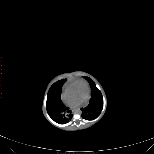 File:Autosomal recessive polycystic kidney disease associated with Caroli disease (Radiopaedia 61932-69984 B 90).jpg