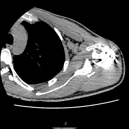 File:Avascular necrosis after fracture dislocations of the proximal humerus (Radiopaedia 88078-104653 D 46).jpg