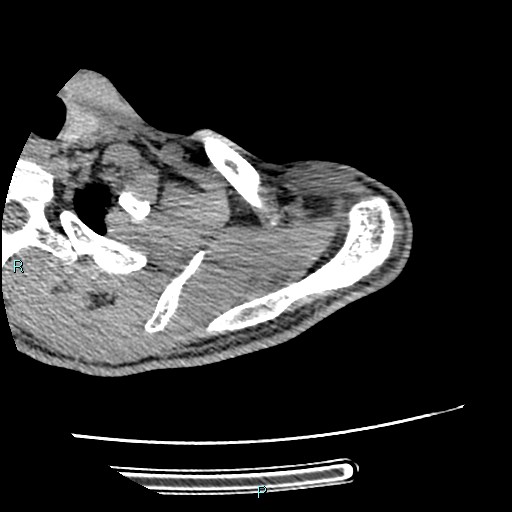 File:Avascular necrosis after fracture dislocations of the proximal humerus (Radiopaedia 88078-104655 D 29).jpg