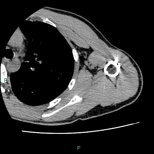 File:Avascular necrosis after fracture dislocations of the proximal humerus (Radiopaedia 88078-104655 D 71).jpg