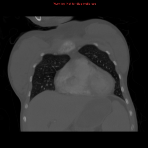 File:Avascular necrosis in sickle cell disease (Radiopaedia 17448-17152 Coronal bone window 33).jpg
