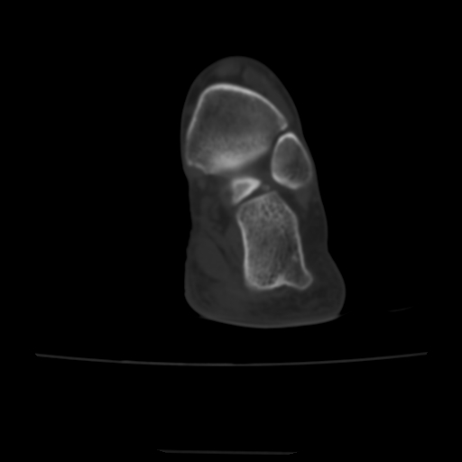 Avulsion fracture of the dorsal cuboid bone (Radiopaedia 51586-57377 Axial bone window 4).jpg