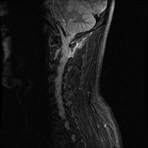 File:Axis fracture - MRI (Radiopaedia 71925-82375 Sagittal STIR 7).jpg