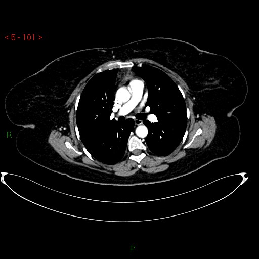 Azygos fissure and lobe (Radiopaedia 47620-52278 A 87).jpg