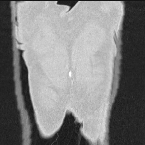 Azygos lobe (Radiopaedia 38259-40275 Coronal lung window 76).jpg