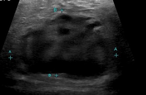 File:B-cell lymphoma - breast (Radiopaedia 18587).jpg