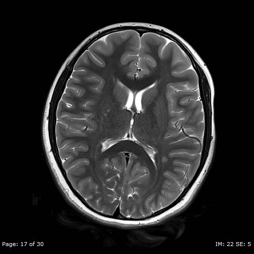 File:Balo concentric sclerosis (Radiopaedia 61637-69636 Axial T2 17).jpg