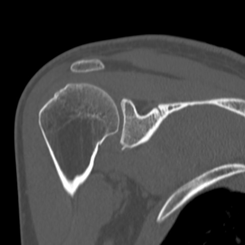 Bankart lesion (Radiopaedia 57256-64185 Coronal bone window 26).jpg