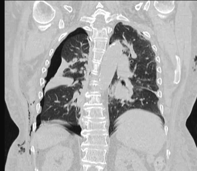 Barotrauma due to mechanical ventilation (Radiopaedia 28079-28336 Coronal lung window 65).jpg