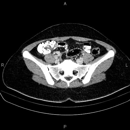 File:Bartholin gland cyst (Radiopaedia 62635-70930 Axial Post contrast 22).jpg
