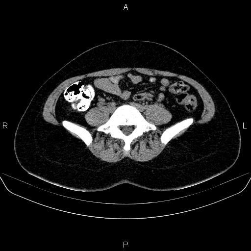 Bartholin gland cyst (Radiopaedia 62635-70930 Axial non-contrast 5).jpg