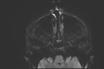File:Basal cell carcinoma - nasal region (Radiopaedia 70292-80365 Axial DWI 31).jpg