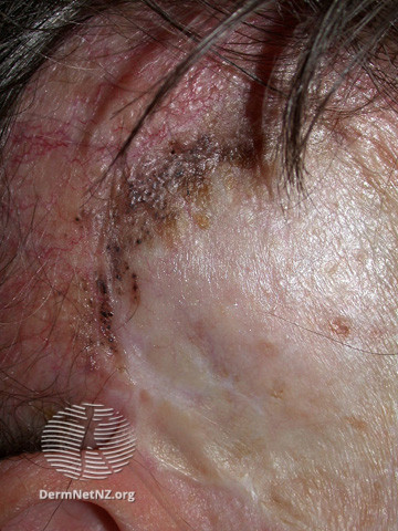 File:Basal cell carcinoma affecting the face (DermNet NZ lesions-bcc-face-1080).jpg