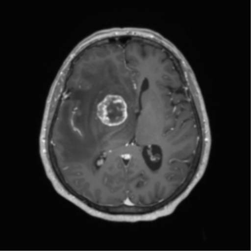 Basal ganglia metastasis (Radiopaedia 78928-91828 Axial T1 C+ 38).png