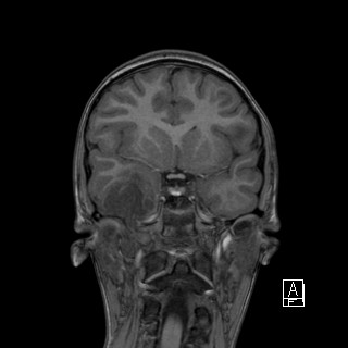Base of skull rhabdomyosarcoma (Radiopaedia 32196-33142 Coronal T1 18).jpg