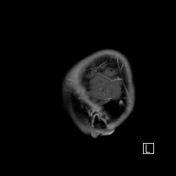 Base of skull rhabdomyosarcoma (Radiopaedia 32196-33142 J 57).jpg