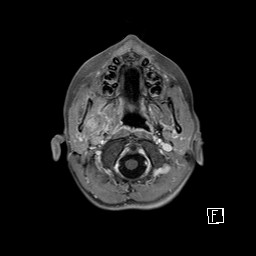 File:Base of skull rhabdomyosarcoma (Radiopaedia 32196-33142 T1 C+ fat sat 20).jpg