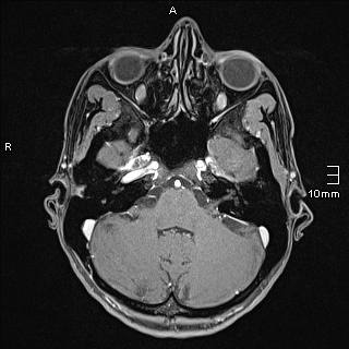 Basilar artery perforator aneurysm (Radiopaedia 82455-99523 G 26).jpg