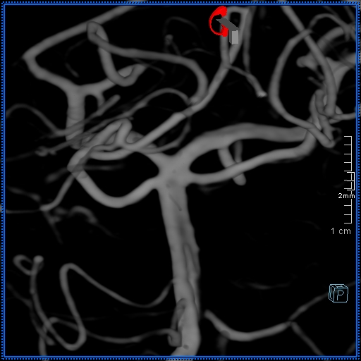 Basilar artery perforator aneurysm (Radiopaedia 82455-99524 3D Left VA 3).jpg