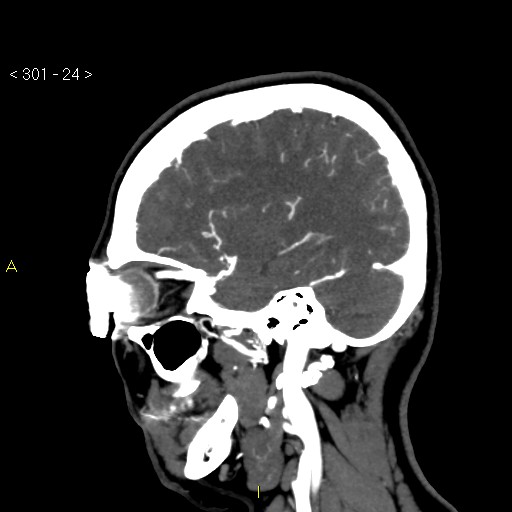 Basilar artery thrombosis (Radiopaedia 16260-15944 C 18).jpg