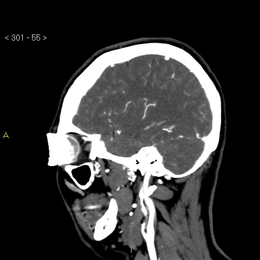 Basilar artery thrombosis (Radiopaedia 16260-15944 C 49).jpg