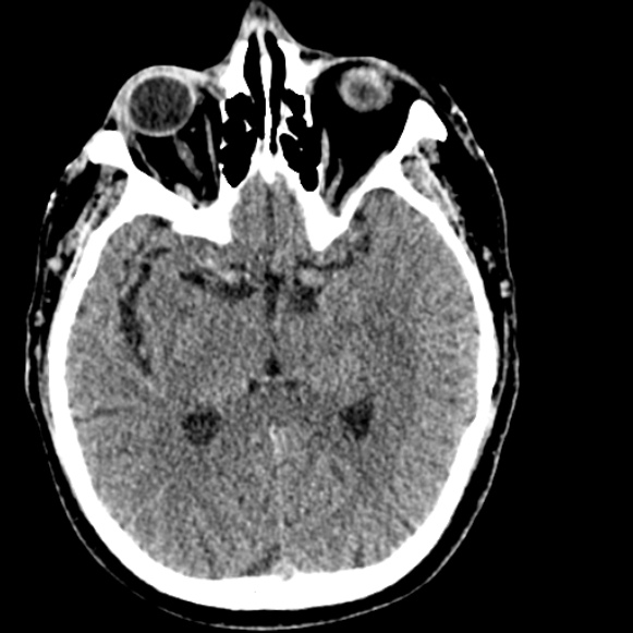 Basilar artery thrombosis (Radiopaedia 53351-59333 Axial non-contrast 60).jpg