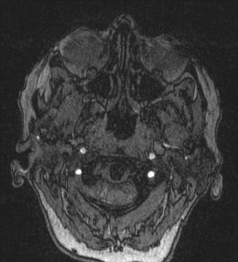 Basilar tip aneurysm (Radiopaedia 26504-26632 MRA 2).jpg