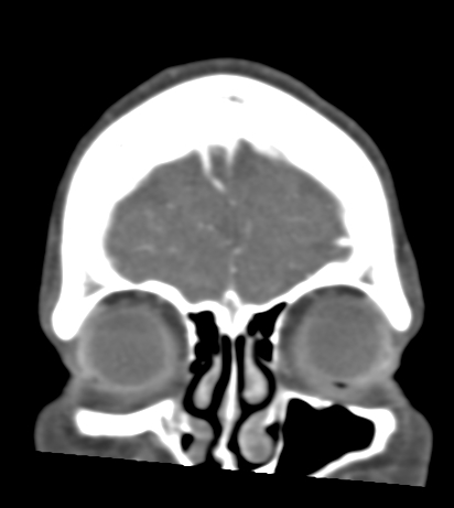 Basilar tip aneurysm with coiling (Radiopaedia 53912-60086 B 11).jpg