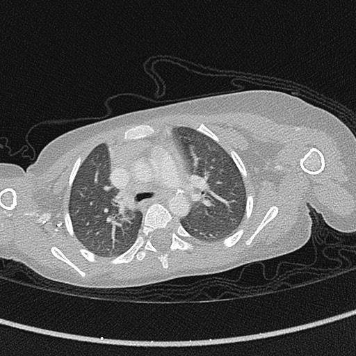 File:Beckwith-Wiedeman syndrome with bilateral Wilms tumors (Radiopaedia 60850-68629 Axial lung window 24).jpg