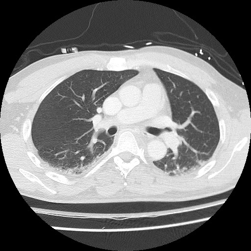Benign post-traumatic pseudopneumoperitoneum (Radiopaedia 71199-81495 Axial lung window 35).jpg