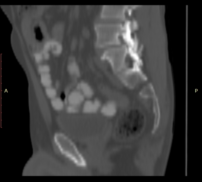 Bertolotti syndrome (Radiopaedia 58974-66235 Sagittal bone window 34).jpg