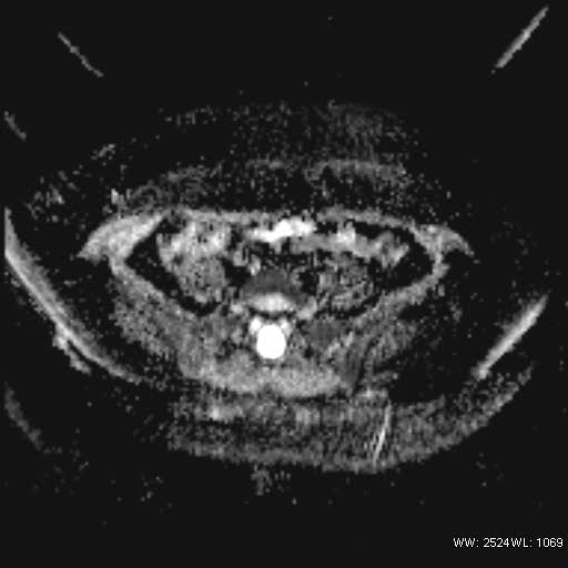 File:Bicornuate uterus- on MRI (Radiopaedia 49206-54297 Axial ADC 5).jpg