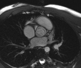 File:Bicuspid aortic valve with aortic coarctation (Radiopaedia 29895-30410 Oblique SSFP Cine 3).jpg
