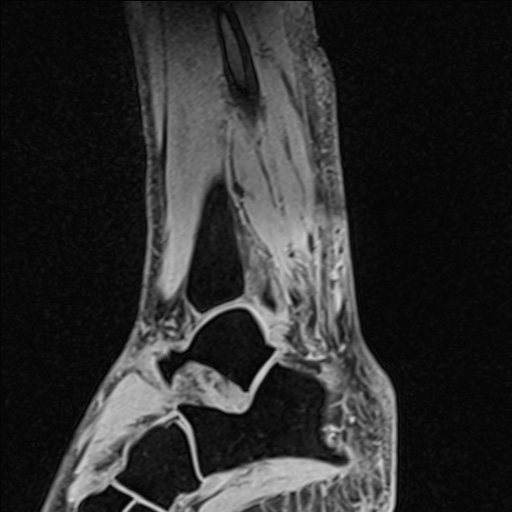 Bilateral Achilles tendon complete tear (Radiopaedia 81344-95051 Sagittal WE - Left 79).jpg