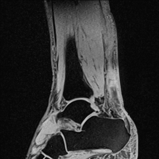 File:Bilateral Achilles tendon complete tear (Radiopaedia 81344-95051 Sagittal WE - Right 44).jpg