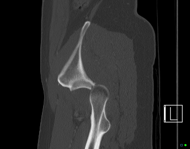 Bilateral acetabular fractures (Radiopaedia 79272-92308 Sagittal bone window 75).jpg
