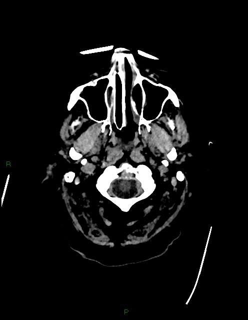 Bilateral acute middle cerebral artery territory infarcts (Radiopaedia 77319-89401 Axial non-contrast 1).jpg