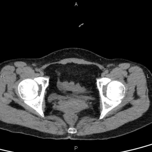 File:Bilateral adrenal gland hyperenhancement in pancreatitis (Radiopaedia 86642-102753 Axial non-contrast 104).jpg