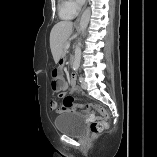 Bilateral adrenal granulocytic sarcomas (chloromas) (Radiopaedia 78375-91007 C 78).jpg