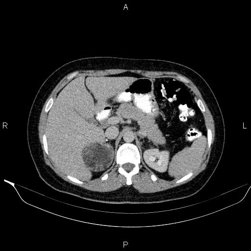 File:Bilateral adrenal myelolipoma (Radiopaedia 63058-71535 Axial C+ delayed 24).jpg
