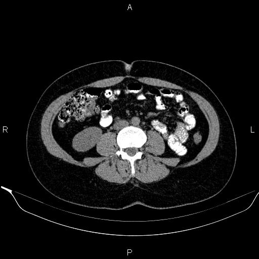 Bilateral adrenal myelolipoma (Radiopaedia 63058-71535 Axial non-contrast 99).jpg
