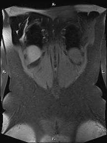 File:Bilateral adrenal myelolipoma (Radiopaedia 63058-71537 Coronal T1 fat sat 12).jpg