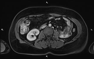 Bilateral adrenal myelolipoma (Radiopaedia 63058-71537 G 58).jpg